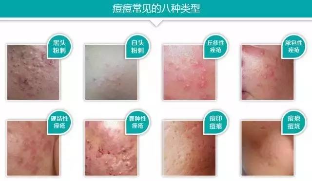 祛痘小窍门掌握了就不会有烦恼,最全祛痘攻略快速祛痘不留痕