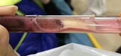 一岁男童吃了它全身发青，还抽出蓝紫色血……医生这样说！