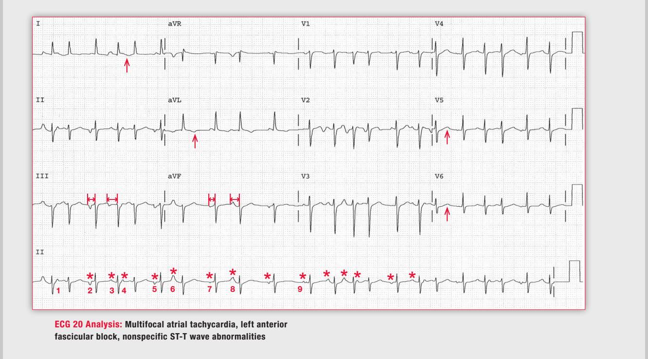 「读心有术」164期：这种多源性房速需要治疗吗？