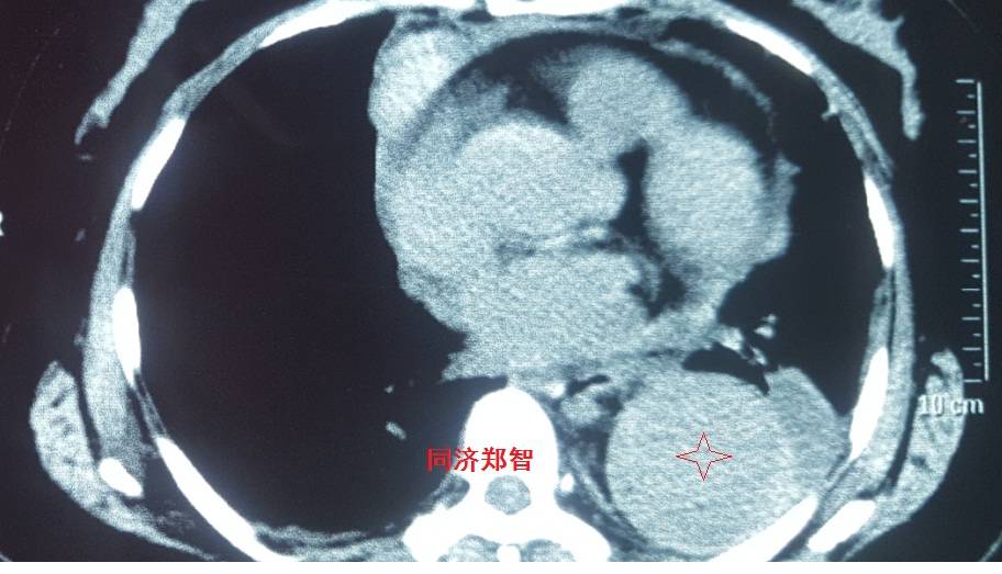 急性主动脉夹层cta影像诊断与鉴别,冠状动脉cta能够看到主动脉夹层吗