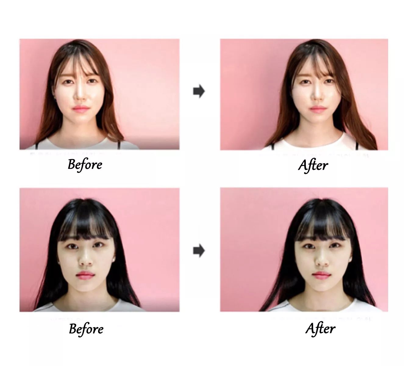 医学瘦脸的方法有哪些不打针,瘦脸除了打针还能够有什么方法