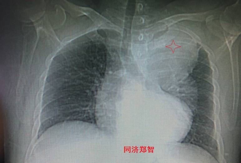 急性主动脉夹层cta影像诊断与鉴别,冠状动脉cta能够看到主动脉夹层吗