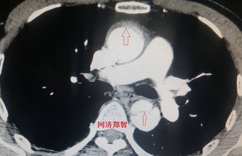 急性主动脉夹层cta影像诊断与鉴别,冠状动脉cta能够看到主动脉夹层吗