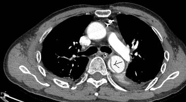急性主动脉夹层cta影像诊断与鉴别,冠状动脉cta能够看到主动脉夹层吗