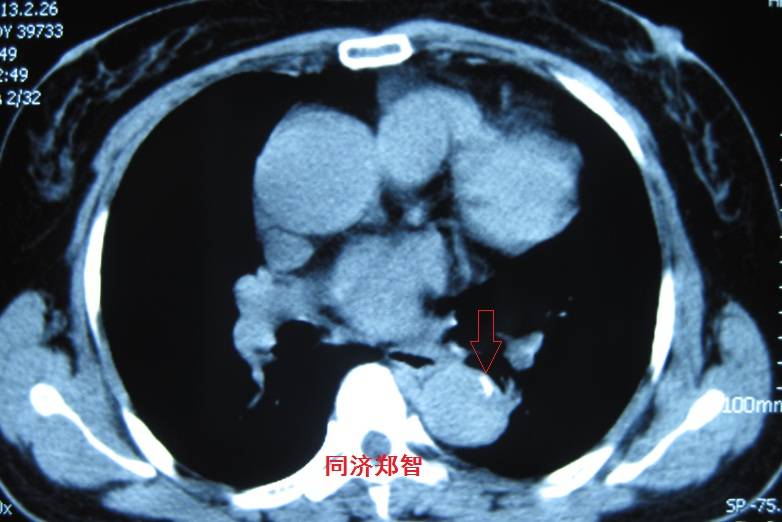 急性主动脉夹层cta影像诊断与鉴别,冠状动脉cta能够看到主动脉夹层吗
