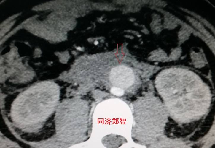 急性主动脉夹层cta影像诊断与鉴别,冠状动脉cta能够看到主动脉夹层吗