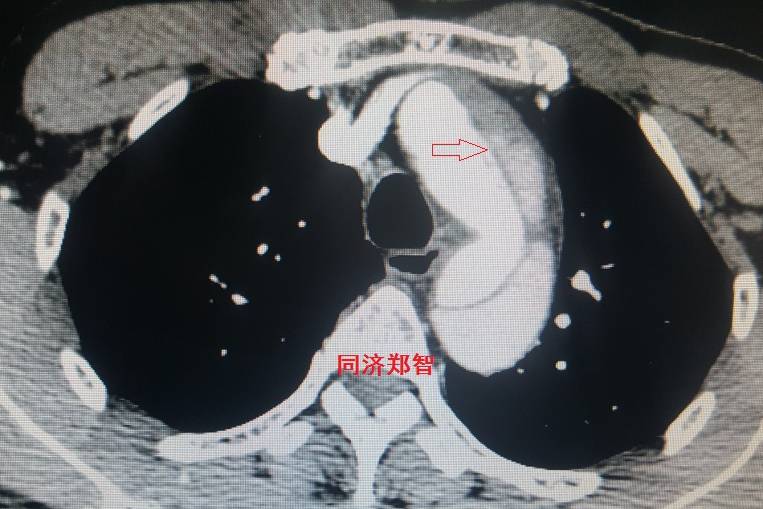 急性主动脉夹层cta影像诊断与鉴别,冠状动脉cta能够看到主动脉夹层吗