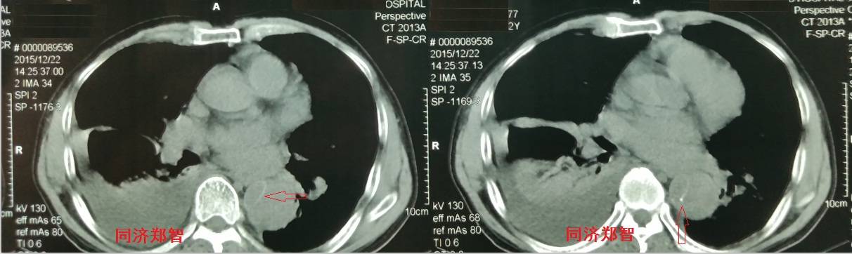 急性主动脉夹层cta影像诊断与鉴别,冠状动脉cta能够看到主动脉夹层吗