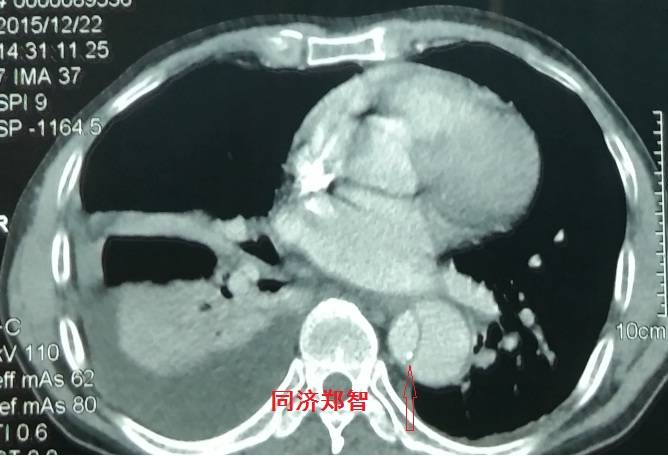 急性主动脉夹层cta影像诊断与鉴别,冠状动脉cta能够看到主动脉夹层吗