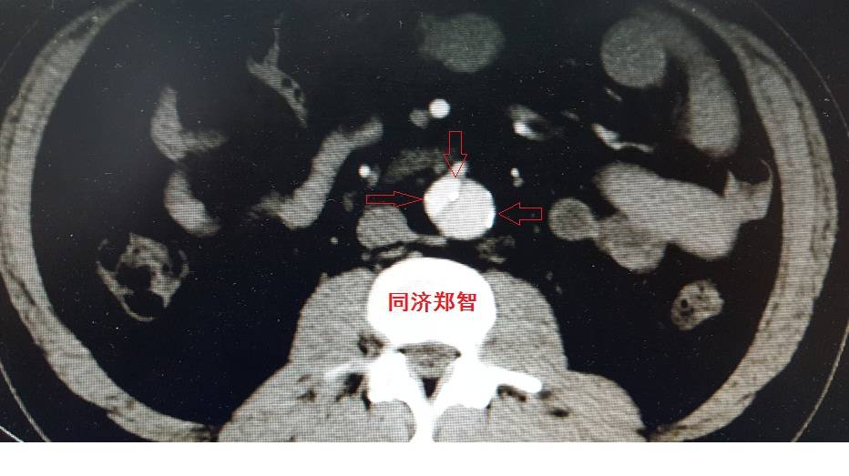 急性主动脉夹层cta影像诊断与鉴别,冠状动脉cta能够看到主动脉夹层吗