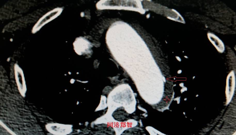 急性主动脉夹层cta影像诊断与鉴别,冠状动脉cta能够看到主动脉夹层吗