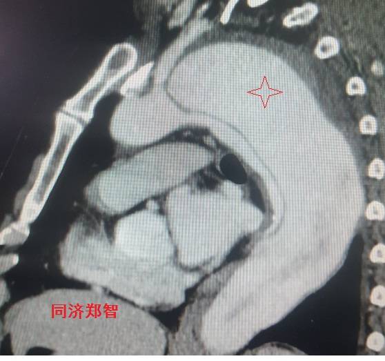 急性主动脉夹层cta影像诊断与鉴别,冠状动脉cta能够看到主动脉夹层吗
