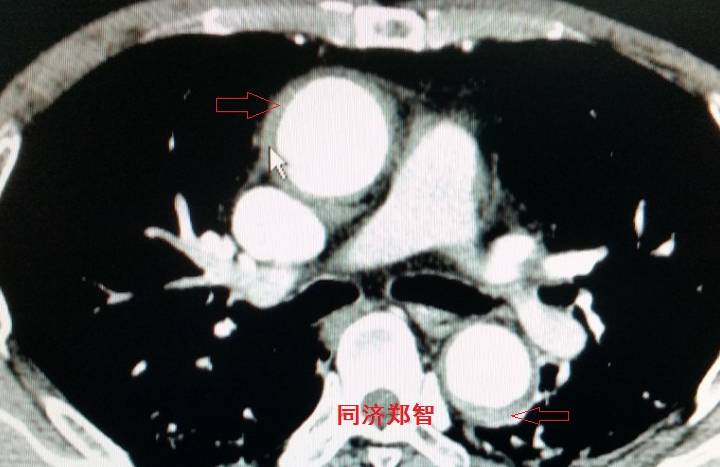 急性主动脉夹层cta影像诊断与鉴别,冠状动脉cta能够看到主动脉夹层吗