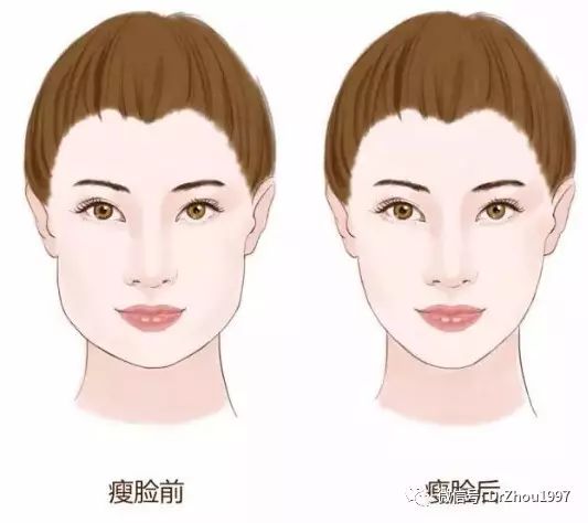 肉毒素矫正大小脸,肉毒素能够改善大小脸吗