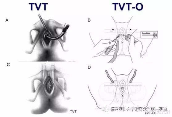笑尿了是病吗,笑尿了是肾的问题吗