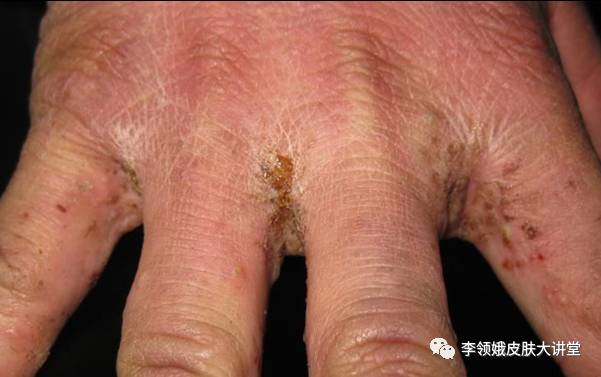 怎样判定身上痒是疥疮,行家治疗皮肤瘙痒症视频