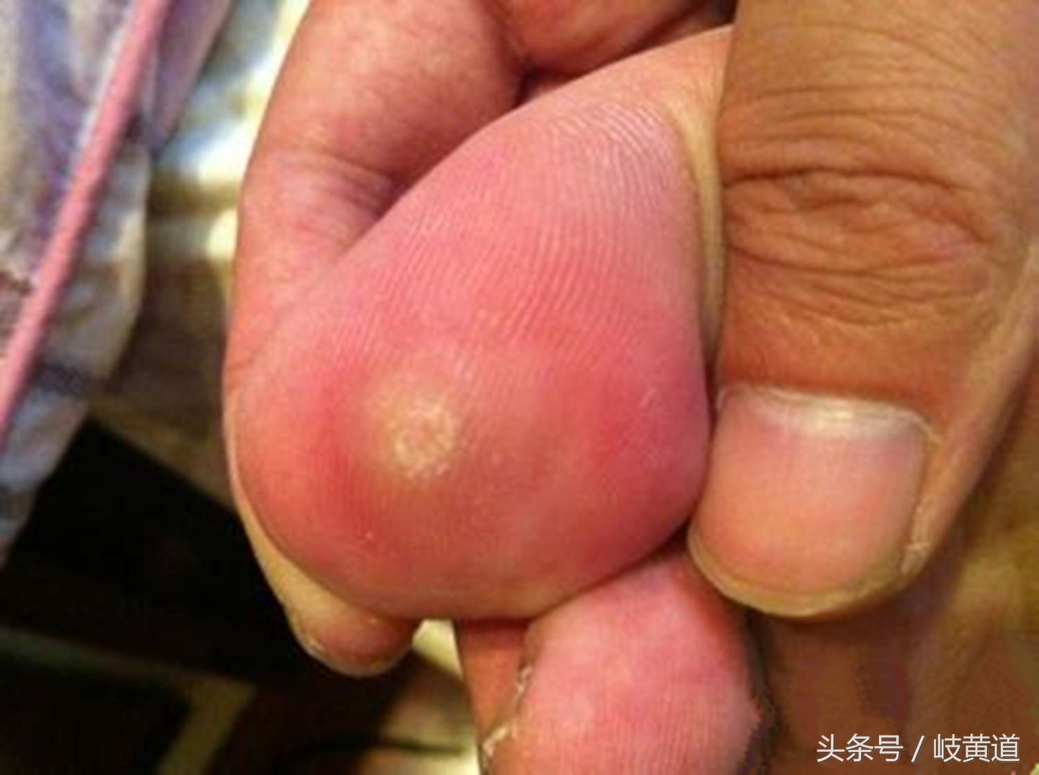 人脚上的鸡眼怎么治除根,很多鸡眼怎么去除