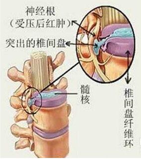 骨质增生长骨刺能手术吗,骨质增生骨刺怎么治才能彻底治好