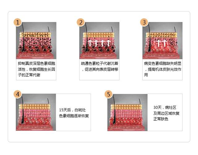 国际目前最有效的治疗白癜风,中国治疗白癜风顶级行家