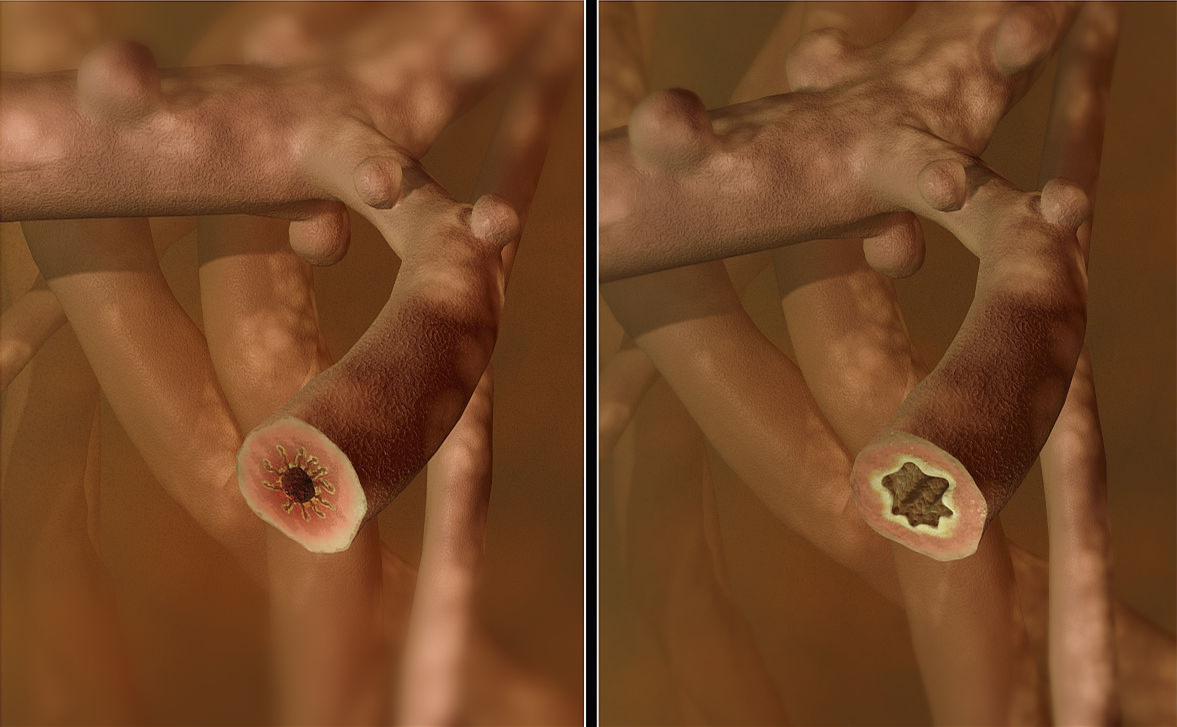 支气管哮喘的发病病因有哪些,支气管哮喘的病因及发病机制