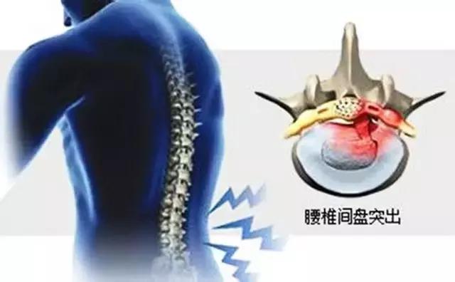 腰椎间盘突出有什么好的治疗方法,70岁老人腰椎间盘突出合适手术吗