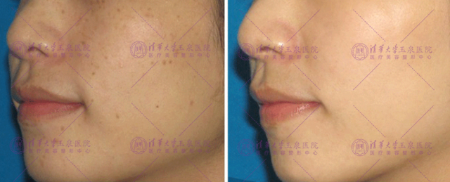 激光夏天做还是冬天做比较好,激光夏天做好还是冬天做好