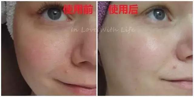 女明星和网红都爱的玻尿酸，保湿、除皱、抗初老，不到百元！