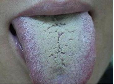 舌苔发黄厚腻口苦口臭舌头上有痰,舌苔厚白口苦口臭是什么症状