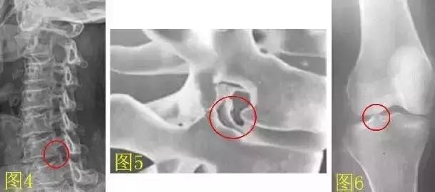 骨刺增生的保健品,药品的宣传能够消除骨刺是真的吗