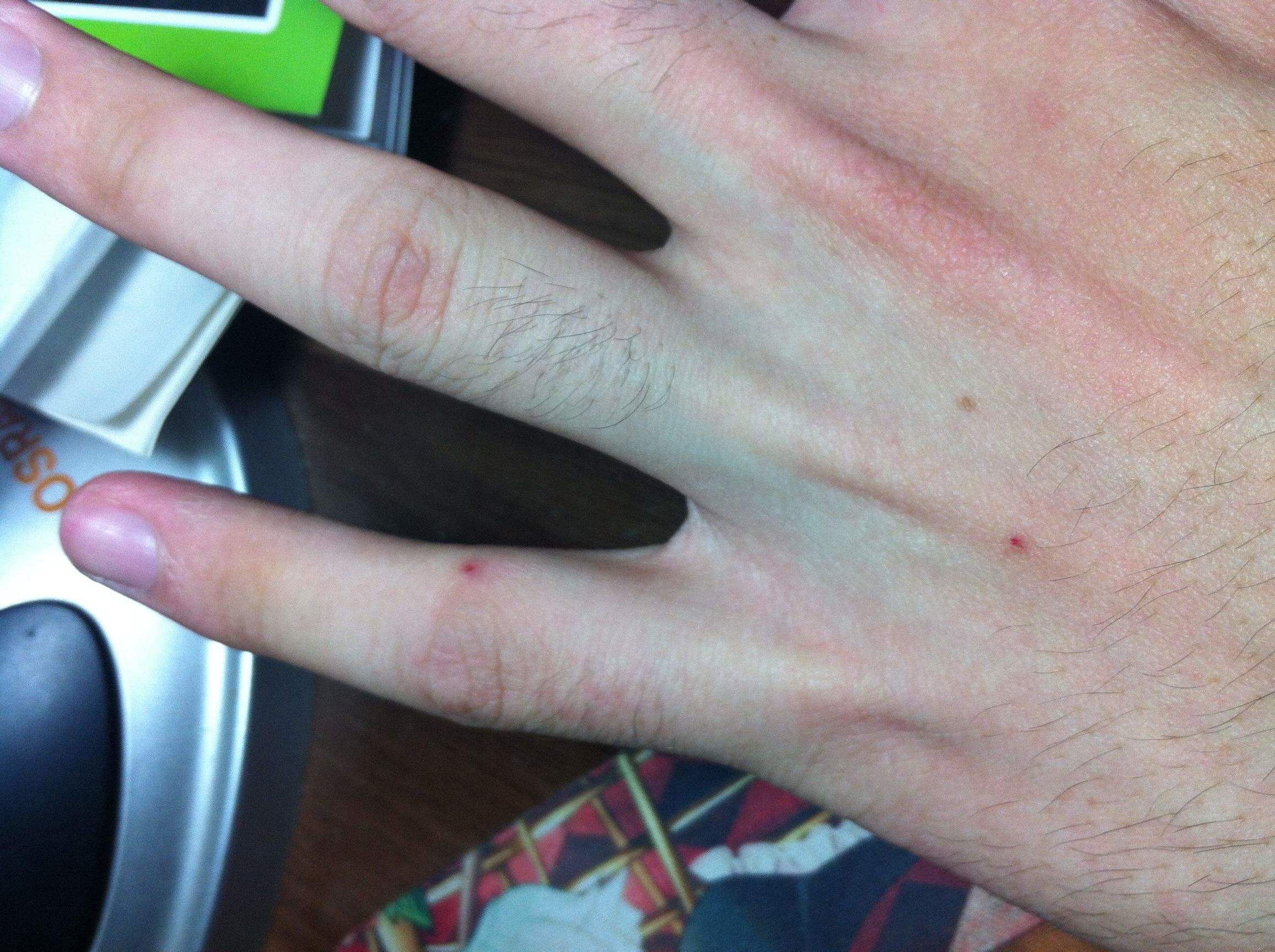 皮肤长小红痣不痛不痒是什么原因,身上长了好多小红痣是什么症状