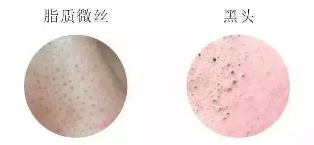 去黑头小妙招你的黑头有救了,别挤了教你去黑头的正确方法