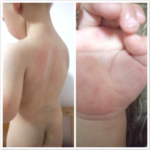 手足口病会传染成疱疹性咽峡炎吗,得了手足口还得疱疹性咽峡炎吗