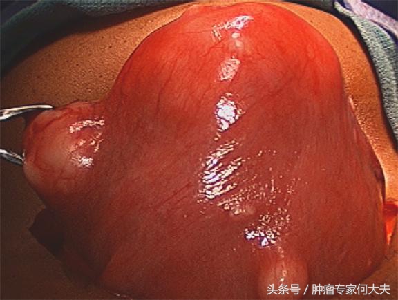 子宫肌瘤5.6公分绝经了还要手术吗,50岁子宫肌瘤7到8厘米需要手术吗