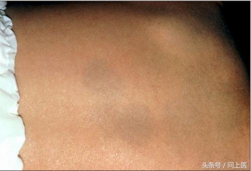 你有胎记吗？图解8种常见胎记