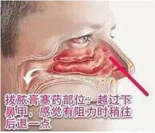 鼻炎鼻窦炎的最佳治疗,鼻炎和鼻窦炎的症状及治疗
