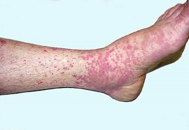 蒙医治疗过敏性紫癜100例疗效研究,雷尼替丁治疗荨麻疹的用量