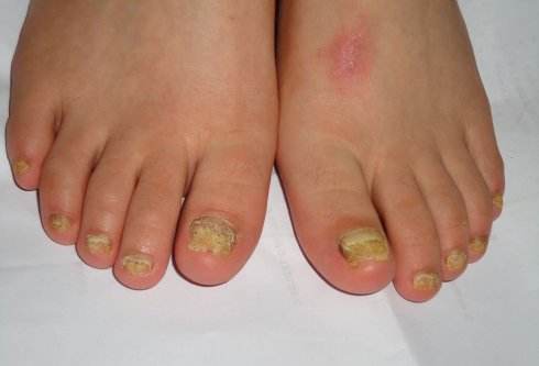 灰指甲康复误区,你一定要知道的灰指甲根治妙招