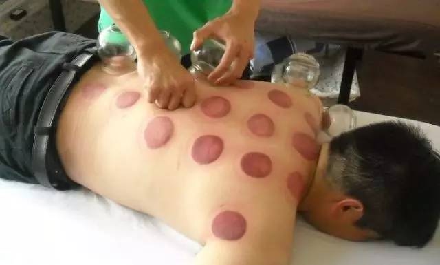 拔罐后不同位置罐印颜色不同,拔罐出现罐斑的原理