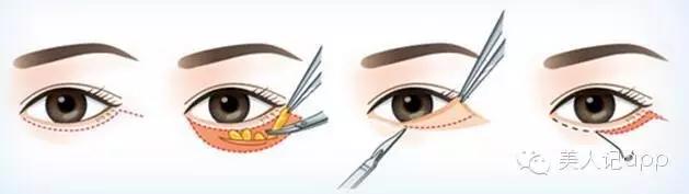 怎么区分眼袋黑眼圈泪沟卧蚕,卧蚕眼袋泪沟黑眼圈