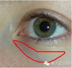 怎么区分眼袋黑眼圈泪沟卧蚕,卧蚕眼袋泪沟黑眼圈
