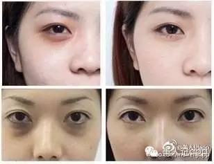怎么区分眼袋黑眼圈泪沟卧蚕,卧蚕眼袋泪沟黑眼圈