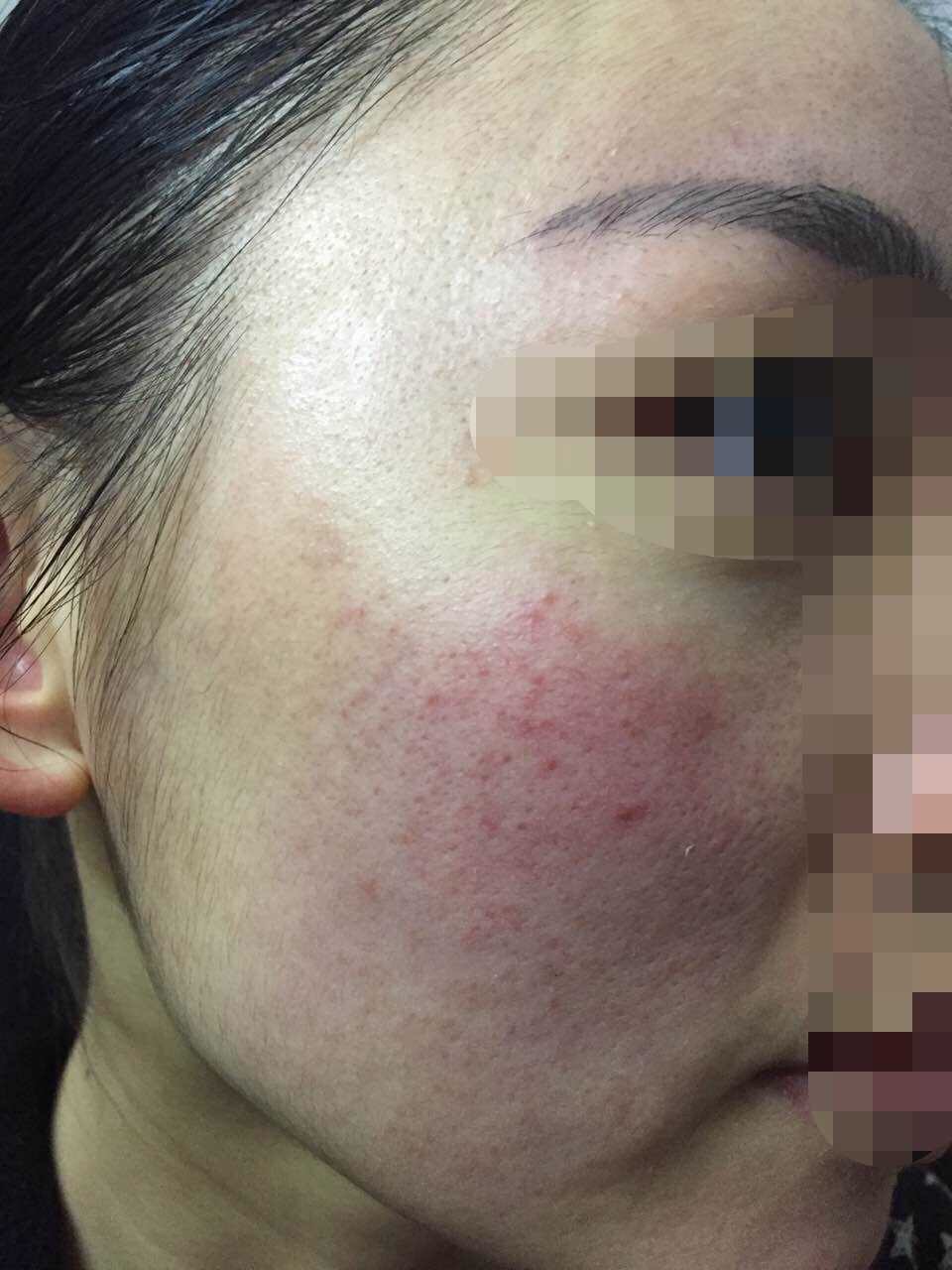 慎入！春季多发激素脸！你还要不要脸？