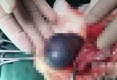 12岁男宝贪玩玩坏小丁丁一侧被迫切除！真相让宝妈悔恨不已！