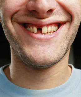 缺失下门牙能够做种植牙吗,门牙缺失不想种植牙怎么办