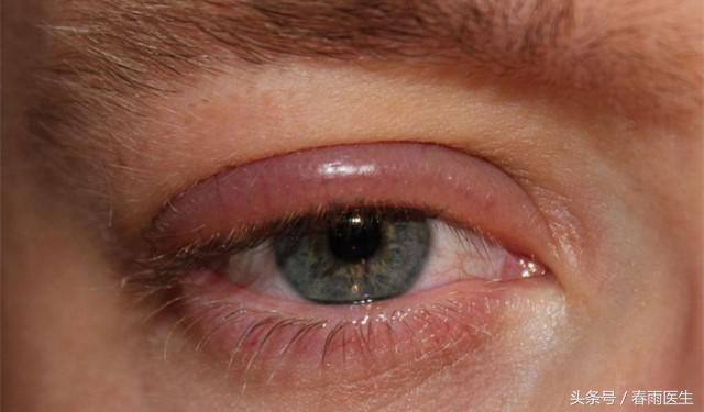 眼睛里面有刺痛感痒怎么回事,小朋友眼睛痒痒总是揉是怎么回事