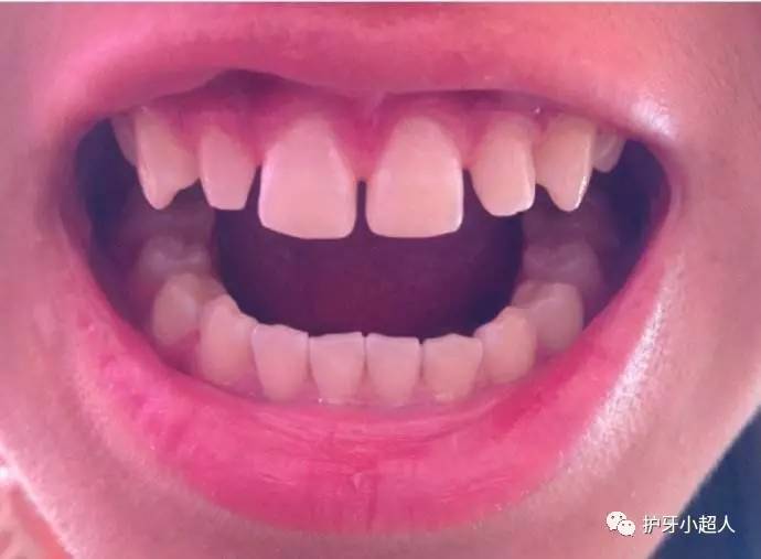 50岁牙缝变大怎么修复,牙缝变大吃什么药能修复