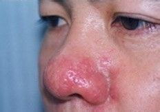 面部有一个危险三角区，这儿的“痘痘”千万不要挤压