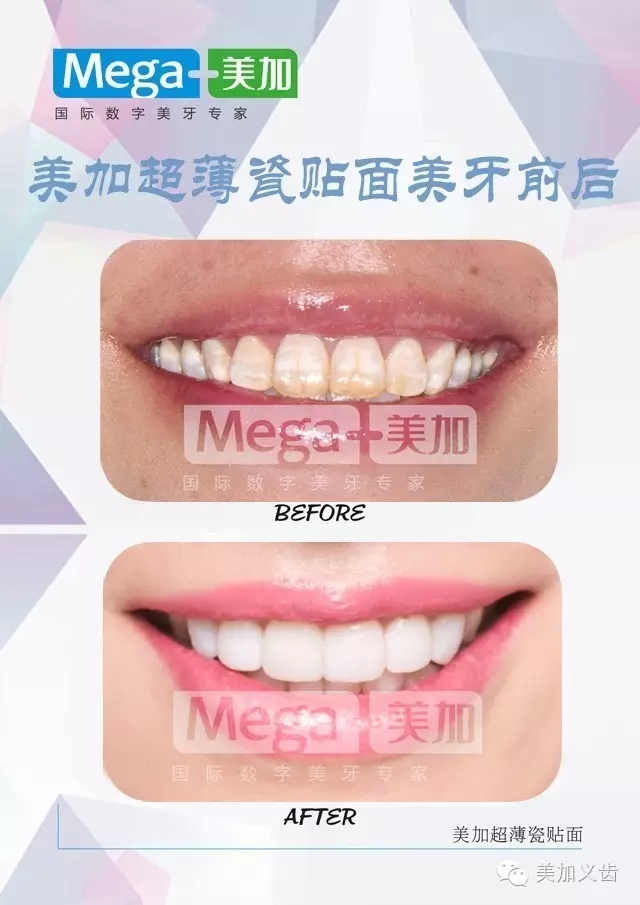 美牙仪和牙斑净哪个好,美白牙贴和医院牙齿美白区别