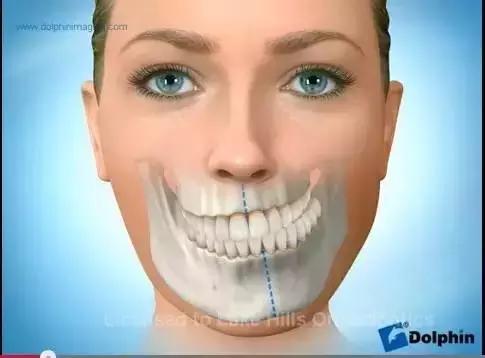 儿童牙颌面畸形的最佳矫正时间,牙颌畸形矫正的最佳年龄是多少