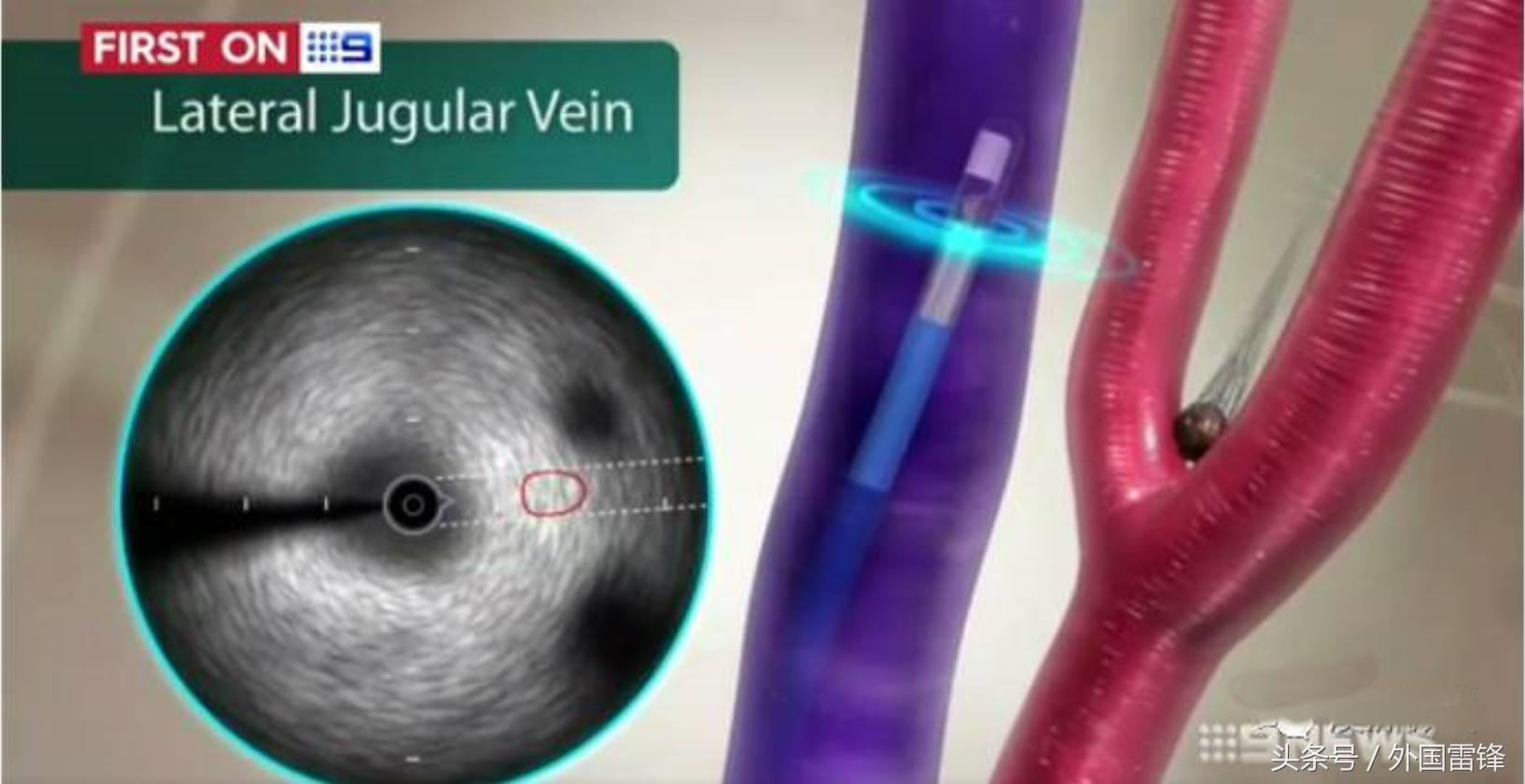 国外高血压防治指南,德国治疗高血压的方法